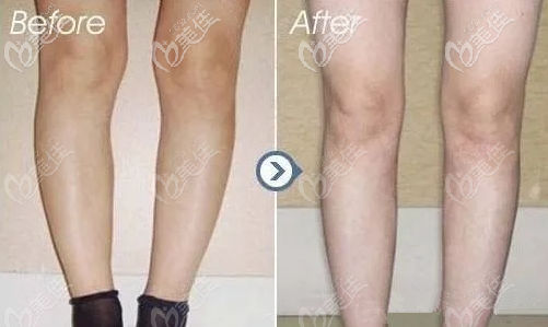 北京雅靓o型腿矫正案例效果 北京雅靓o型腿矫正案例效果