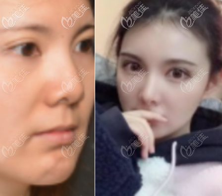 李劲良鼻小柱延长手术恢复30天的术前术后对比图