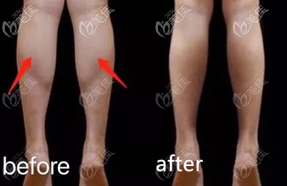 北京雅靓哪个医生能做0型腿矫正 北京雅靓哪个医生能做0型腿矫正