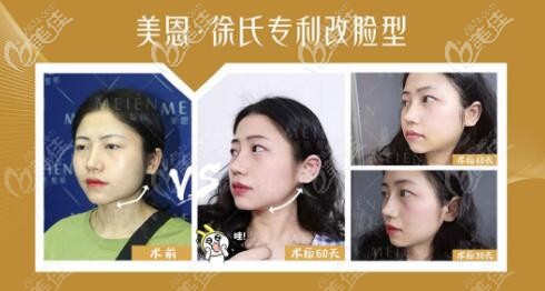 徐威强改脸型真人案例对比效果图