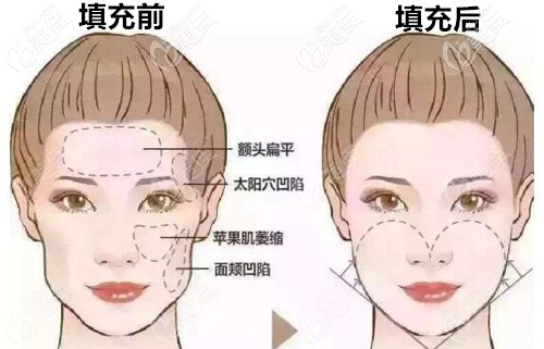 采用脂肪胶填充面部术前术后详细对比
