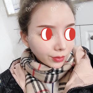 二次补胶后顾客面部自然饱满