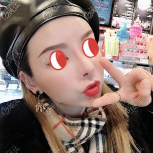 初次填充术后48天脸颊轻微凹陷