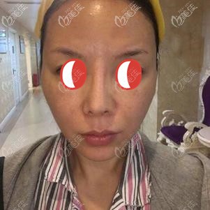 做脂肪胶填充全脸前顾客面部凹陷
