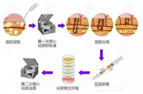 提取脂肪胶的手术示意图