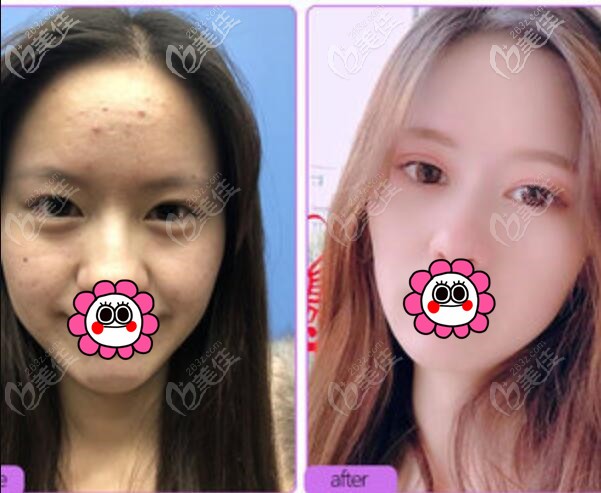 宁波美莱郑景芳双眼皮案例