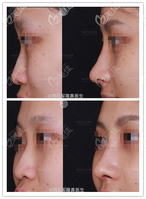 刘彦军初鼻效果