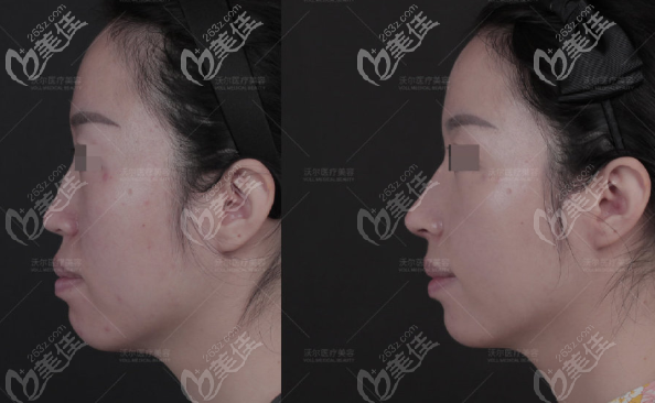 北京沃尔肋软骨隆鼻案例