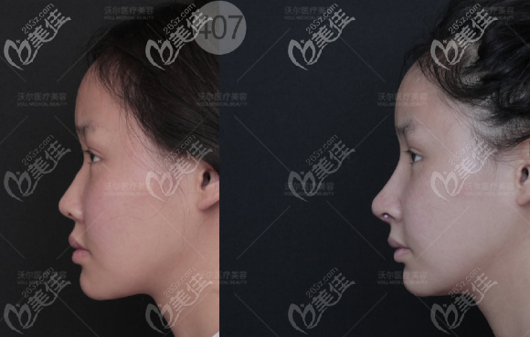 刘彦军膨体鼻综合案例