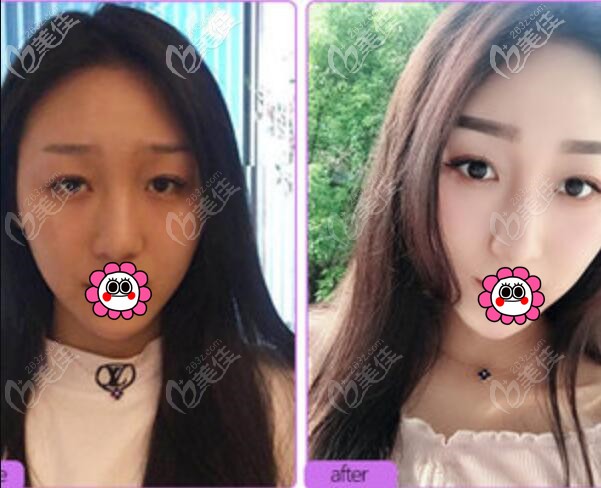 宁波美莱孙明磊鼻综合案例