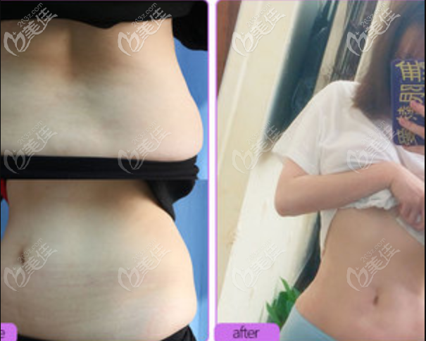 宁波美莱姚远腰腹吸脂案例