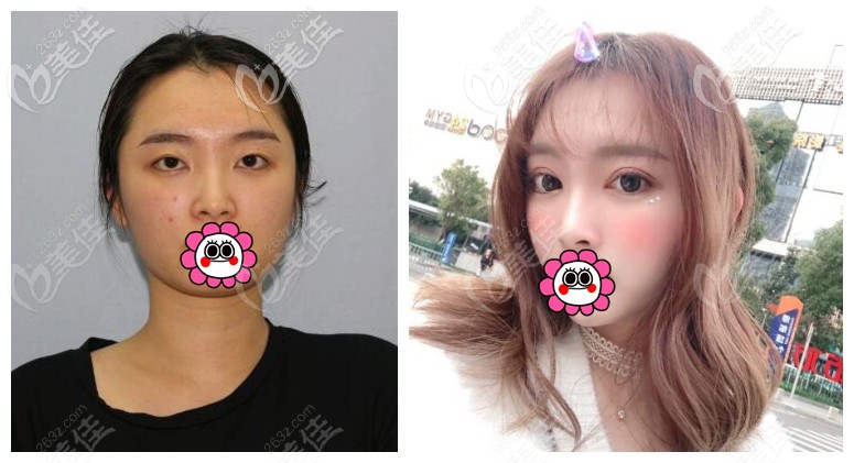 宁波薇琳雷艳莉双眼皮案例