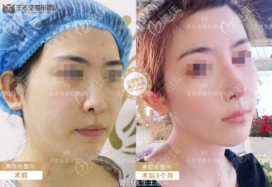 北京京民医院鼻综合案例