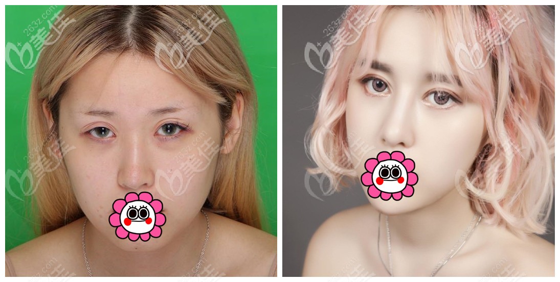 宁波薇琳张广巍隆鼻案例