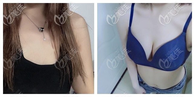 宁波薇琳曾举假体隆胸案例