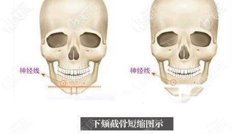 长下巴截骨术 长下巴截骨术