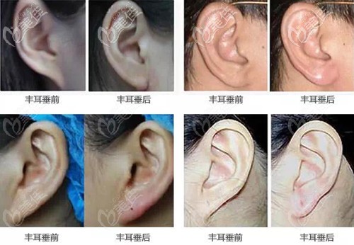 丰耳垂前后对比案例 丰耳垂前后对比案例