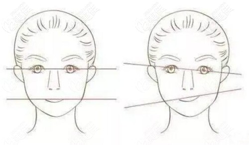 面部歪斜的自测方法 面部歪斜的自测方法