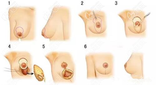 双环法乳房下垂矫正术示意图 双环法乳房下垂矫正术示意图