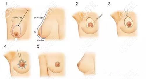乳房塑形悬吊术示意图 乳房塑形悬吊术示意图