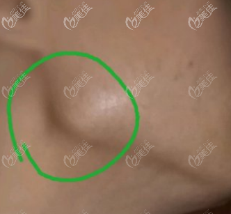 下颌角外翻图 下颌角外翻图