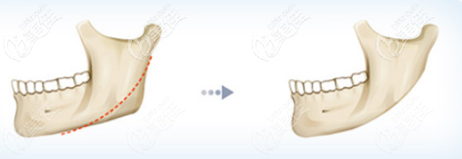 下颌角手术效果 下颌角手术效果