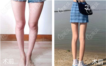 x型腿矫正术前术后对比照片