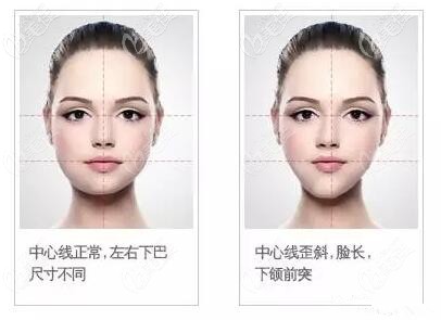 下巴歪斜的矫正方法 下巴歪斜的矫正方法