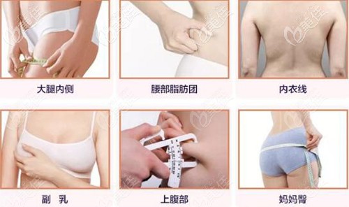 酷塑溶脂可以解决的部位