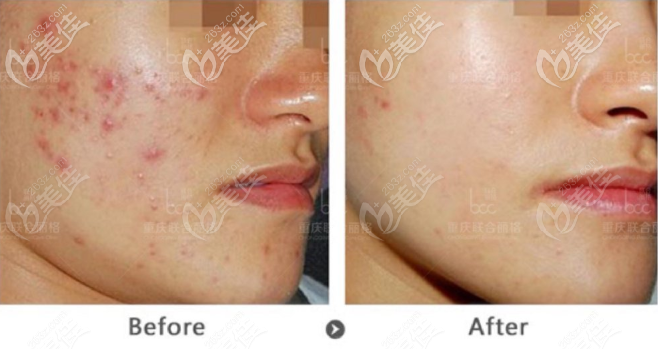 重庆联合丽格M22祛痘印效果