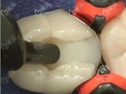 牙齿缺损充填治疗