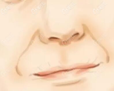 鼻唇沟也叫法令纹 鼻唇沟也叫法令纹