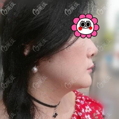 下颌缘吸脂术前照 下颌缘吸脂术前照