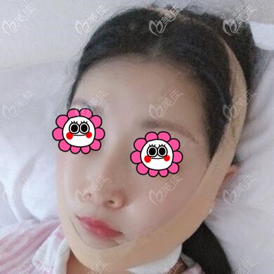 下颌缘吸脂术后当天 下颌缘吸脂术后当天