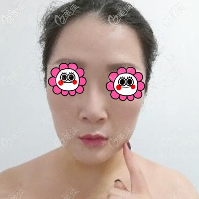 下颌缘吸脂术后6天效果 下颌缘吸脂术后6天效果