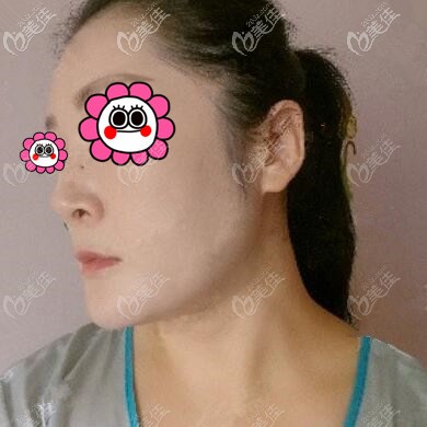 下颌缘吸脂术后20天效果照 下颌缘吸脂术后20天效果照