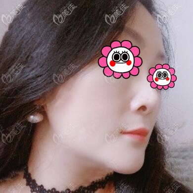 双下巴吸脂术后32天效果照 双下巴吸脂术后32天效果照