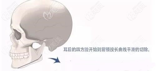 长曲线下颌角手术的部位 长曲线下颌角手术的部位