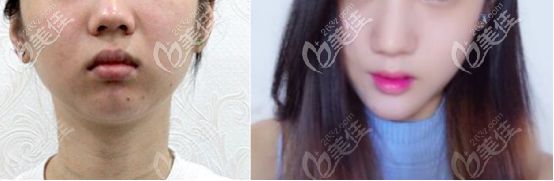 自体脂肪填充下巴30天和术前的对比图片