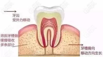 牙齿矫正有年龄限制吗