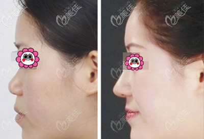 <i data-id='563d96e0-45aa-4866-ad88-254f738e7618' ></li>
<li><i data-id='563d96e0-45aa-4866-ad88-254f738e7618' style='display:none;'></i>硅胶隆鼻案例