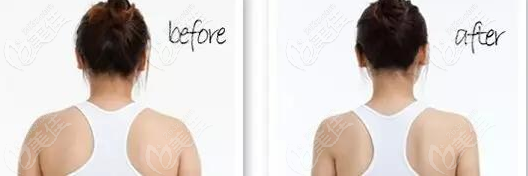 肩背部吸脂对比效果图