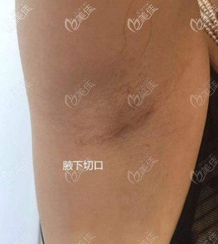 腋下切口恢复1年效果