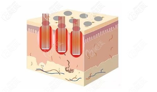 点阵激光治疗原理