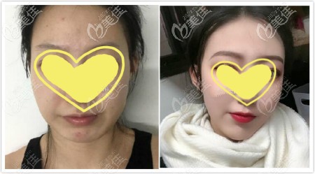 下颌角切除+劈外板截骨真人案例效果图 下颌角切除+劈外板截骨真人案例效果图