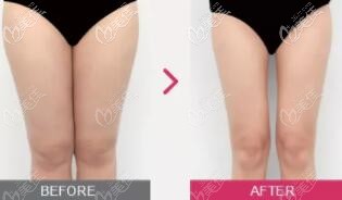 大腿吸脂术前术后对比照 大腿吸脂术前术后对比照