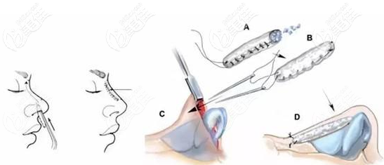 肋骨隆鼻手术过程 肋骨隆鼻手术过程