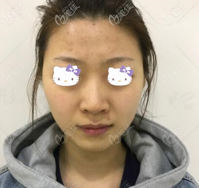 皮秒提亮肤色术前照 皮秒提亮肤色术前照