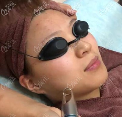 皮秒祛黄祛痘印过程 皮秒祛黄祛痘印过程