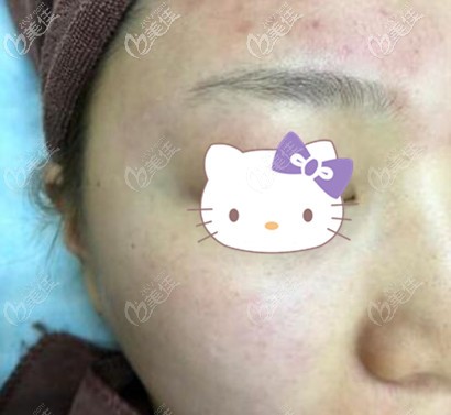 皮秒祛黄提亮肤色术后即刻效果照 皮秒祛黄提亮肤色术后即刻效果照